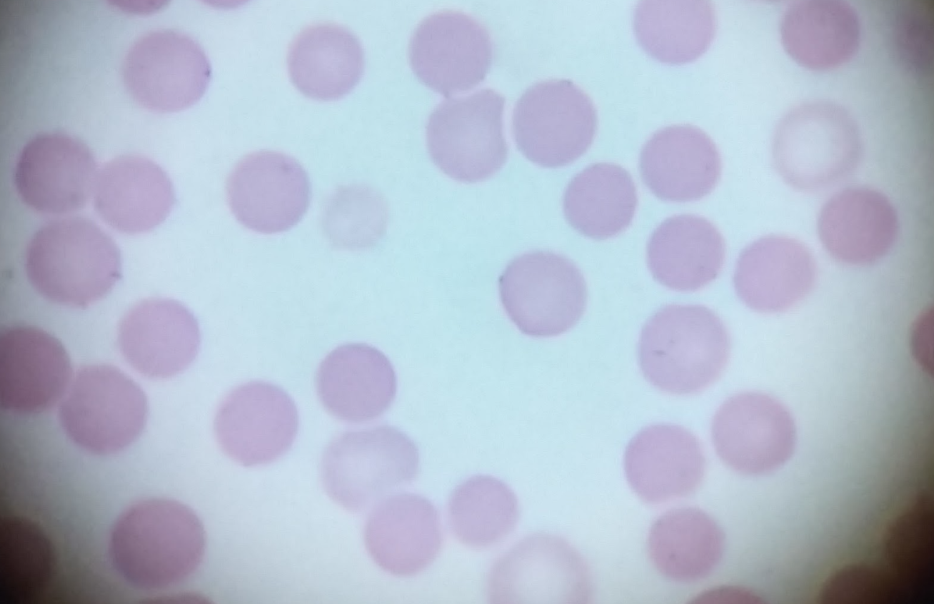 Cuerpos de Heinz en un perro con Severa Anemia Normocítica Normocrómica No regenerativa. Autoría Propia